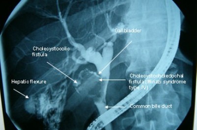 endoscopic retrograde ercp cholangiopancreatography